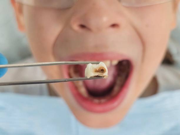Best Emergency Treatment for Toothache in Rutherford College, NC